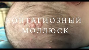 Контагіозний молюск на шкірі: перламутрові вузлики, які з’являються зненацька