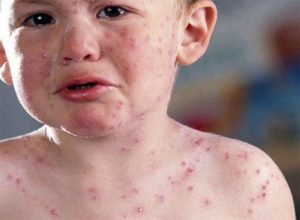 Скільки хворіють вітрянкою: етапи, терміни та нюанси перебігу